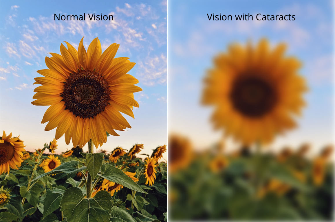 How Do I Know If I Have Cataracts? - Gulf Coast Vision Center